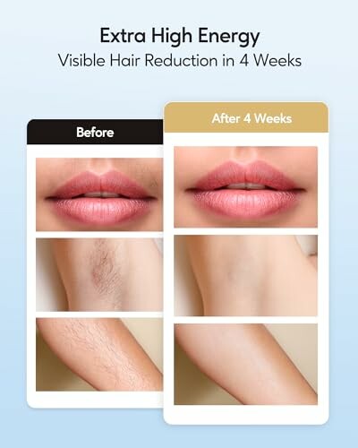 Comparison of visible hair reduction on lips and arms before and after 4 weeks